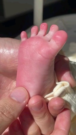 HICH:Baby foot contracts gently after soothing massage.