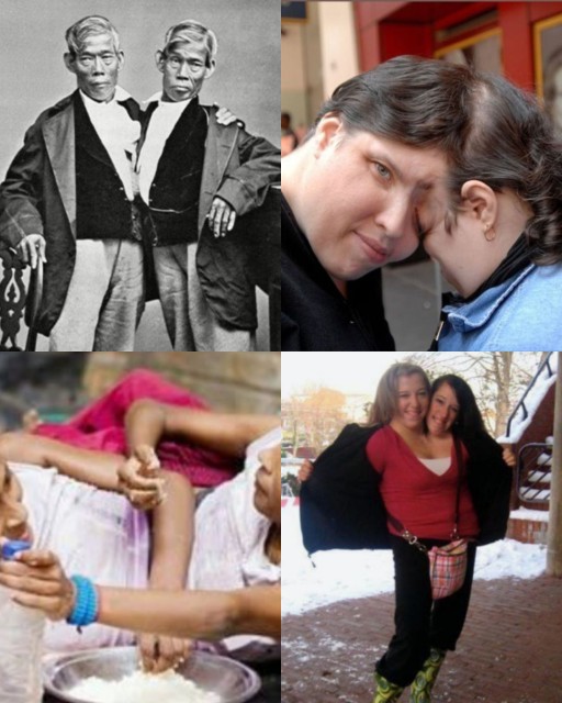 HICH:Which of these conjoined twins do you find the most bizarre-looking?