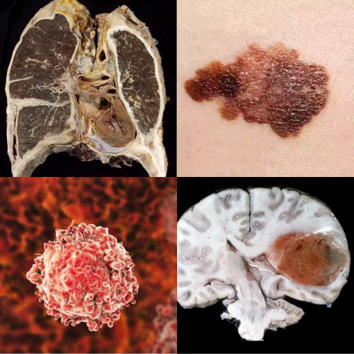 HICH:Which rare cancer is primarily linked to asbestos exposure?
