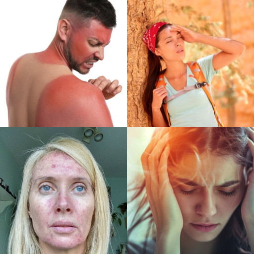 HICH:What is the biggest health impact of excessive sun exposure?